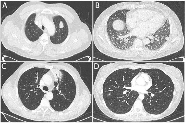 Chụp CT phổi - thăm khám quan trọng hậu Covid